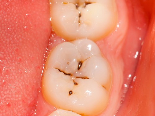 Hướng dẫn cách nhận biết răng chớm bị sâu để xử lý kịp thời.