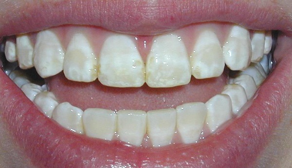 Hướng dẫn cách nhận biết răng chớm bị sâu để xử lý kịp thời.