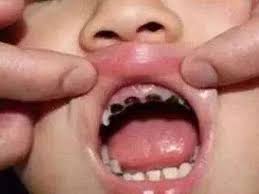 Sâu răng sữa – Nguyên nhân và cách xử lý tức thì