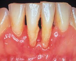 Phòng tránh và điều trị tụt lợi chân răng