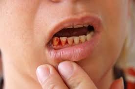 Phòng tránh và điều trị tụt lợi chân răng