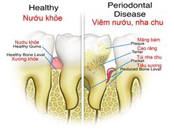 Bệnh răng miệng liên quan đến biến chứng của bệnh tiểu đường